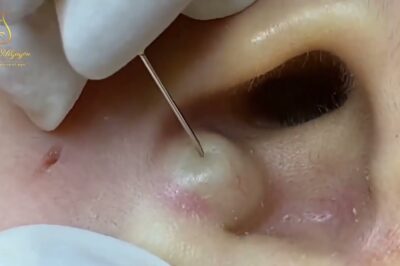 Big cystic acne blackheads extraction whiteheads Removal Pimple Popping