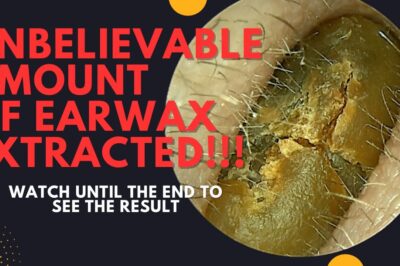 UNBELIEVABLE Amount Of Earwax Extracted From This Ear!!! (Watch Until The End)