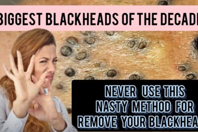 Nasty and lengthy blackhead removal